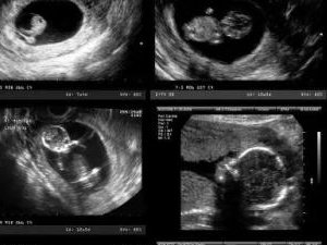 泰国三代试管婴儿价格需要多少钱？